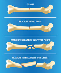 fracture